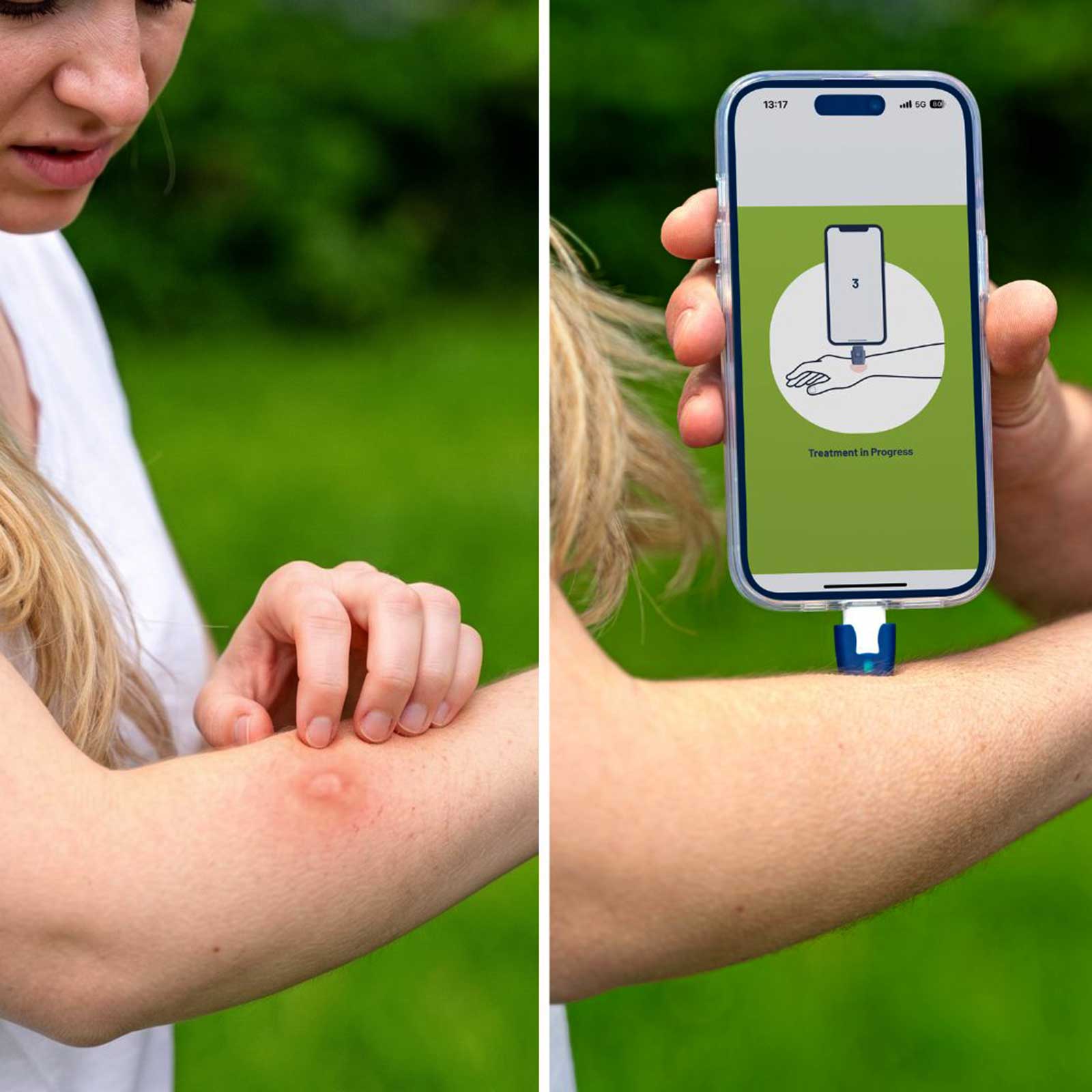 heat it classic – Insektenstichheiler für iPhone & Android – Heatit stichheiler Anwendung auf der haut